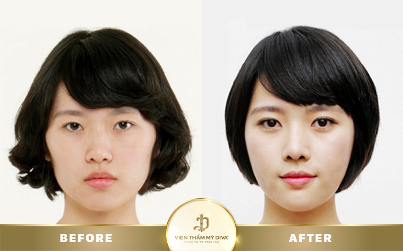 mo-goc-mat-o-can-tho mo-goc-mat-o-can-tho-4