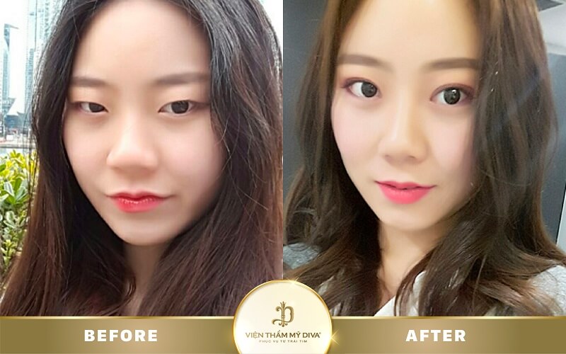 mo-goc-mat-o-can-tho mo-goc-mat-o-can-tho-6