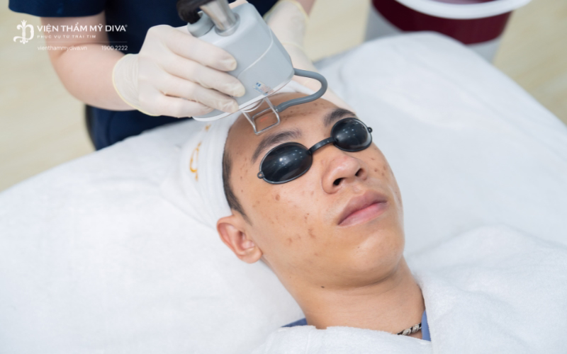 Trị sẹo rỗ cảm giác hơi châm chích và đau rát nhẹ