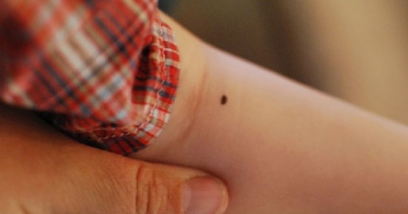 Giải Mã Bí Ẩn Nốt Ruồi Ở Khuỷu Tay: Tướng Số & Sức Khỏe