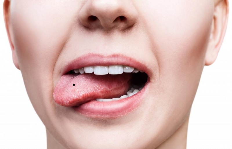 Lưỡi có nốt ruồi 