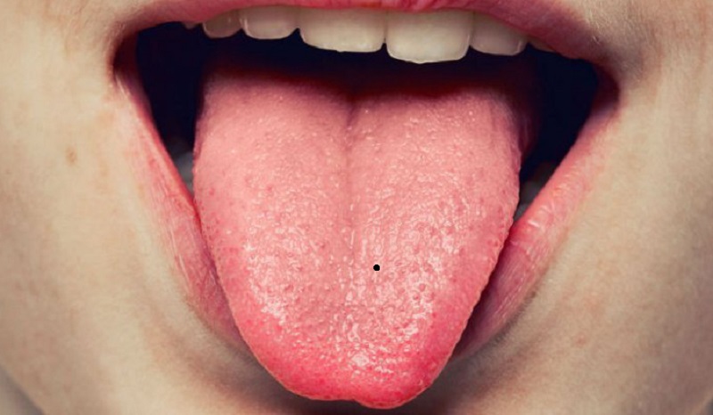 Nốt ruồi giữa lưỡi 