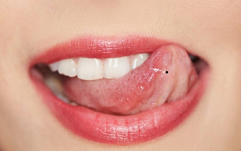 Nốt ruồi ở dưới lưỡi