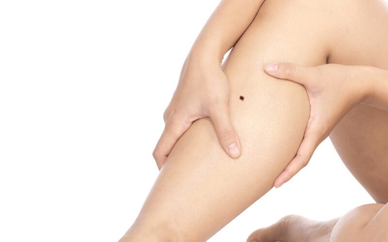 Người sở hữu nốt ruồi ở bắp chân