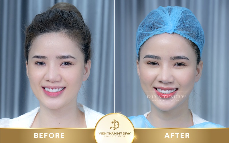 Hình ảnh trước - sau điều trị