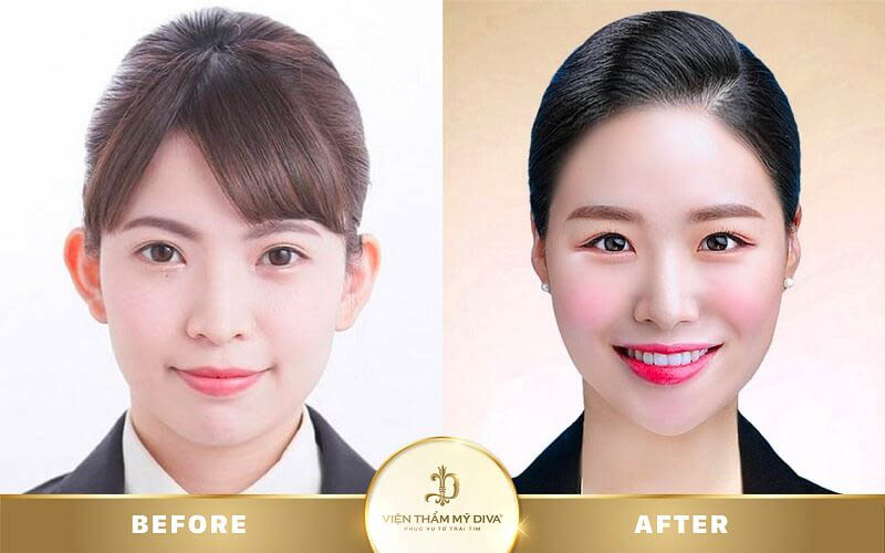 Hình ảnh khách hàng trước và sau phun mí mắt ở Tây Ninh