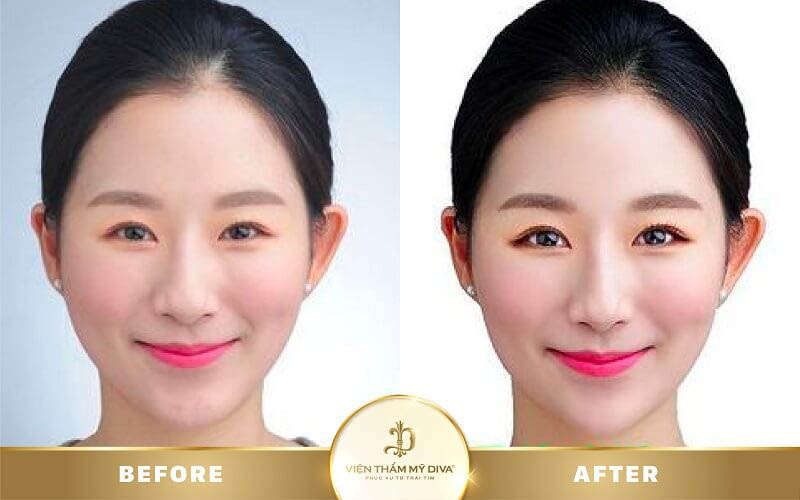 Hình ảnh khách hàng trước và sau phun mí mắt ở Tây Ninh