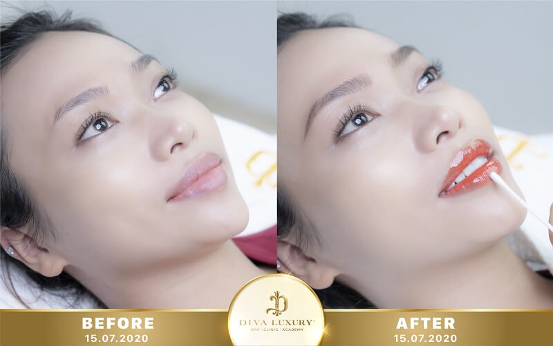 phun môi collagen pha lê