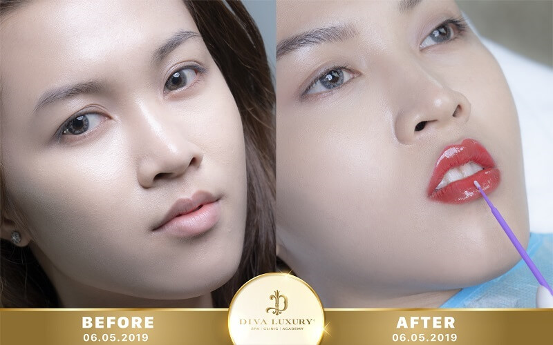 phun môi collagen pha lê