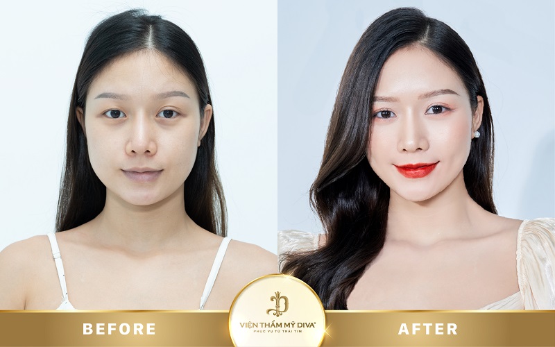 Làm đẹp tại Viện thẩm mỹ DIVA Phước Long