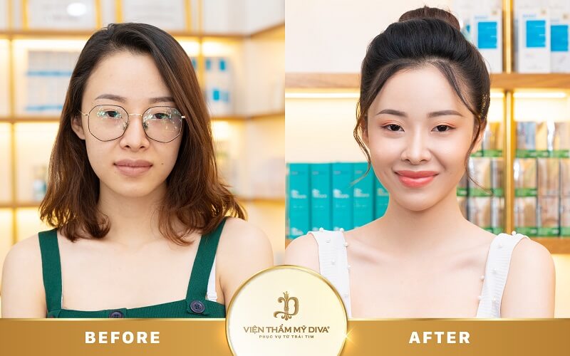 Làm đẹp tại Viện thẩm mỹ DIVA Phước Long