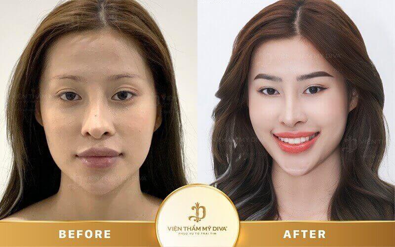Hình ảnh khách hàng sau khi phun môi tế bào gốc thành công tại Viện thẩm mỹ DIVA