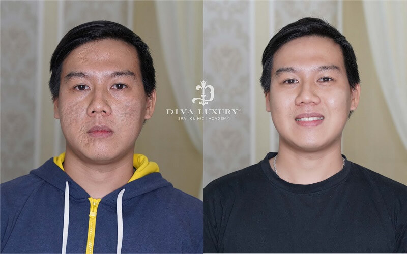laser-fractional-co2-dac-tri-seo-ro-da-co-mat-tai-vien-tham-my-diva-4