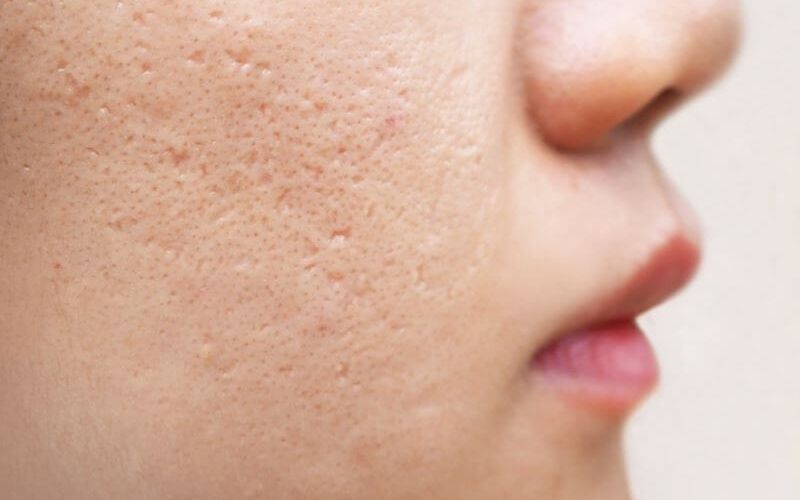 Vì sao cần phải trị sẹo?