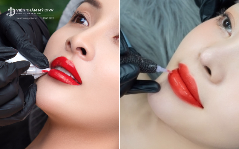 So sánh kỹ thuật phun môi tế bào gốc và phun môi collagen