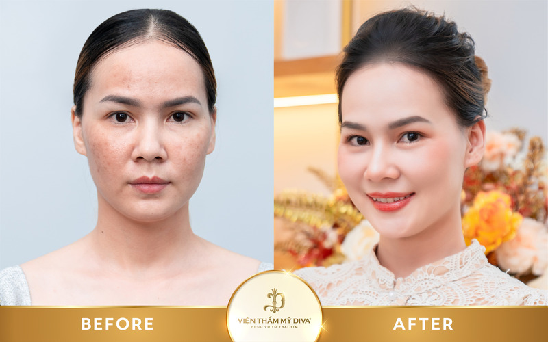 Hình ảnh khách hàng sau khi tái tạo da ở Tây Ninh tại Viện thẩm mỹ DIVA Hình ảnh khách hàng sau khi tái tạo da ở Tây Ninh tại Viện thẩm mỹ DIVA