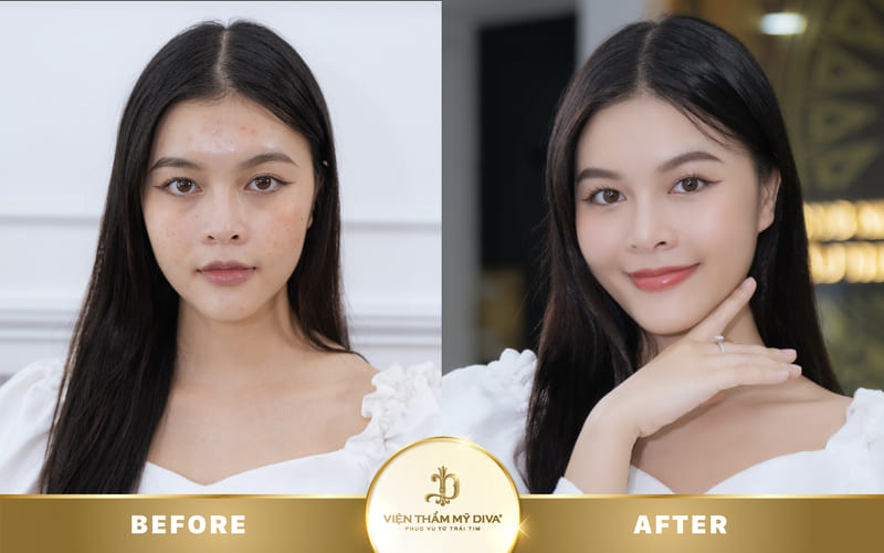 Hình ảnh khách hàng sau khi tái tạo da ở Tây Ninh tại Viện thẩm mỹ DIVA Hình ảnh khách hàng sau khi tái tạo da ở Tây Ninh tại Viện thẩm mỹ DIVA