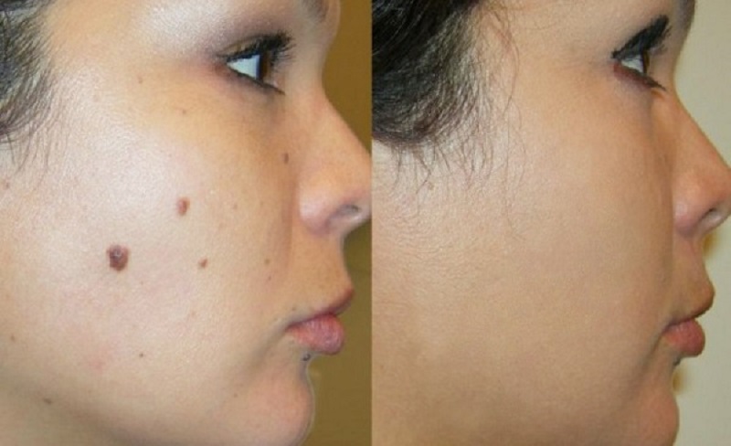 xoa-not-ruoi-da-nang xoa-not-ruoi-tai-da-nang-6