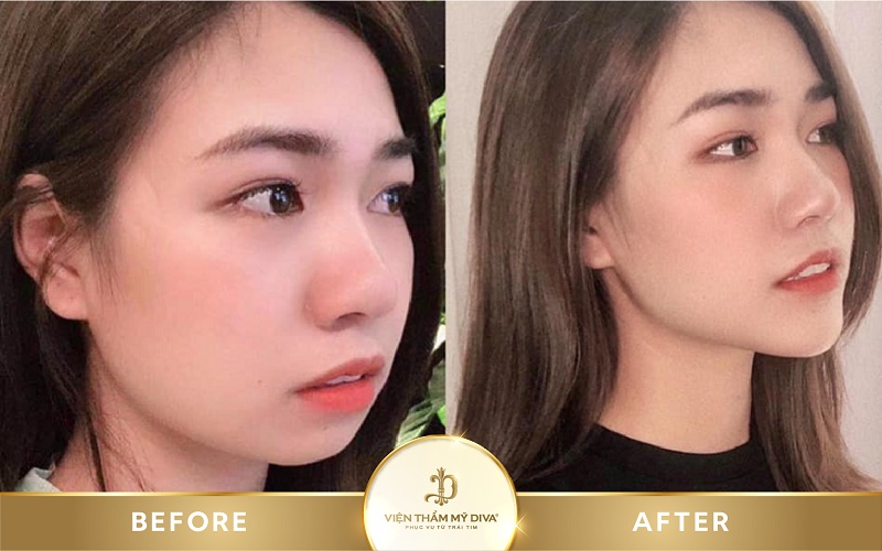 Tiêm Filler là gì? Nguy hiểm không? Giá bao nhiêu? 12