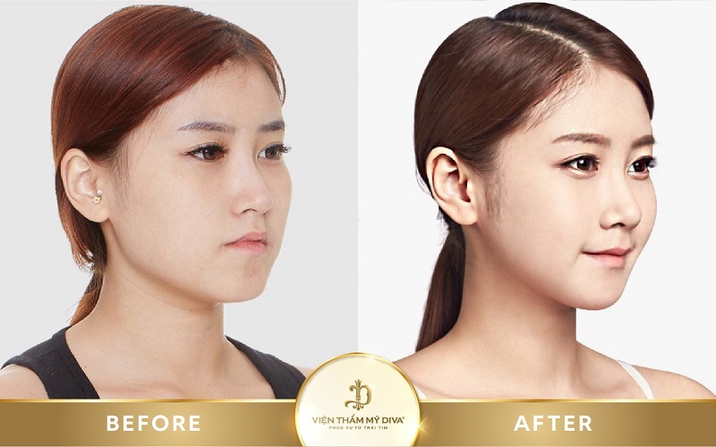 Tiêm Filler là gì? Nguy hiểm không? Giá bao nhiêu? 11