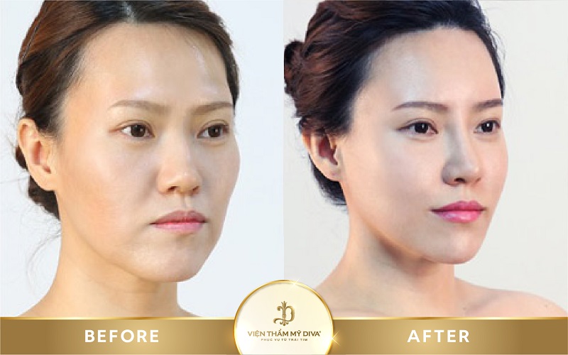 Tiêm Filler là gì? Nguy hiểm không? Giá bao nhiêu? 10