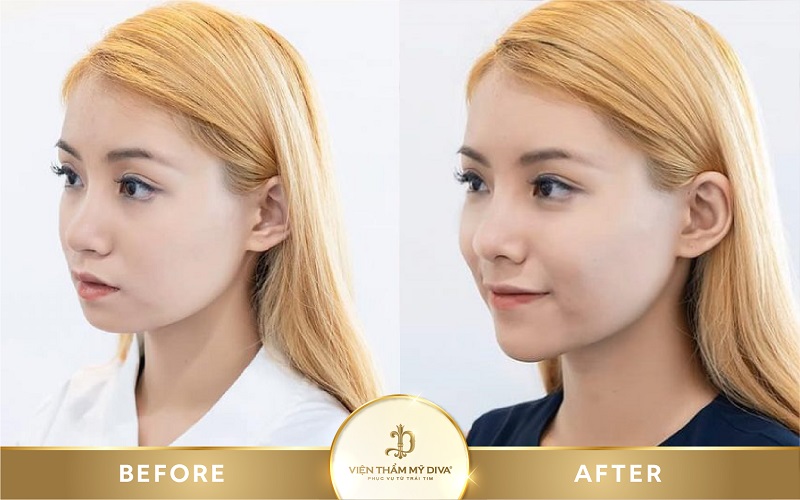 Tiêm Filler là gì? Nguy hiểm không? Giá bao nhiêu? 9