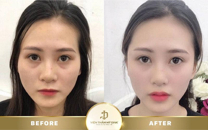 Tiêm Filler là gì? Nguy hiểm không? Giá bao nhiêu? 13