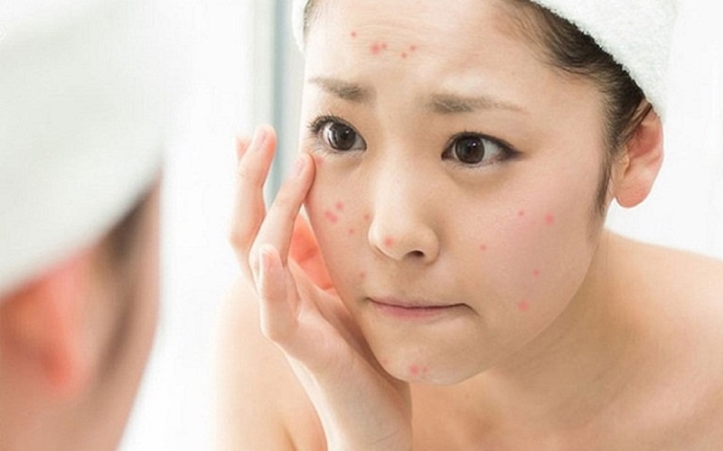 Tiêu chí để lựa chọn địa chỉ điều trị mụn chất lượng