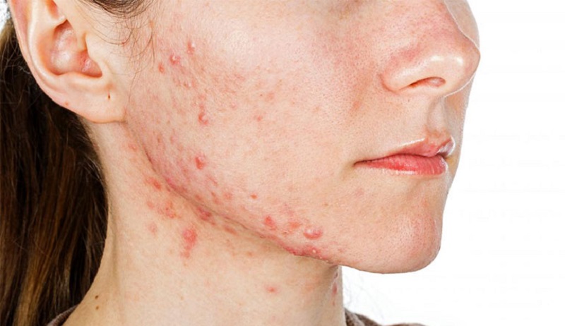 tri-mun-o-thot-not Hậu quả của việc họn giá rẻ