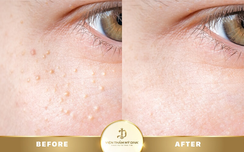 Hình ảnh trước - sau điều trị