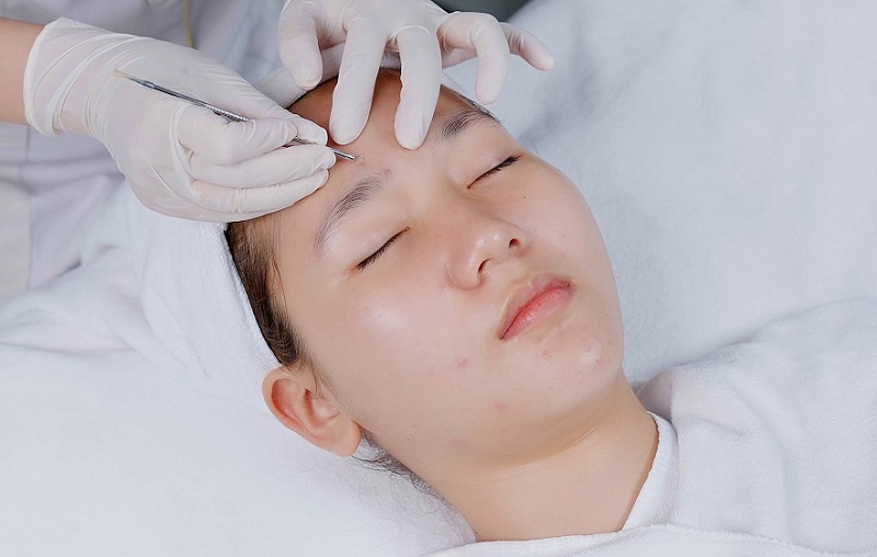 Công nghệ trị mụn tại Viện thẩm mỹ DIVA tiên tiến và hiện đại