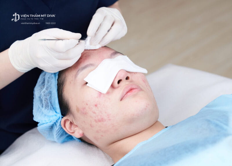 trị mụn tại thủ dầu một