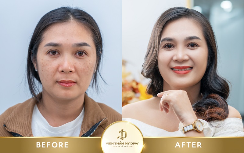 Làm đẹp tại Viện thẩm mỹ DIVA Phước Long