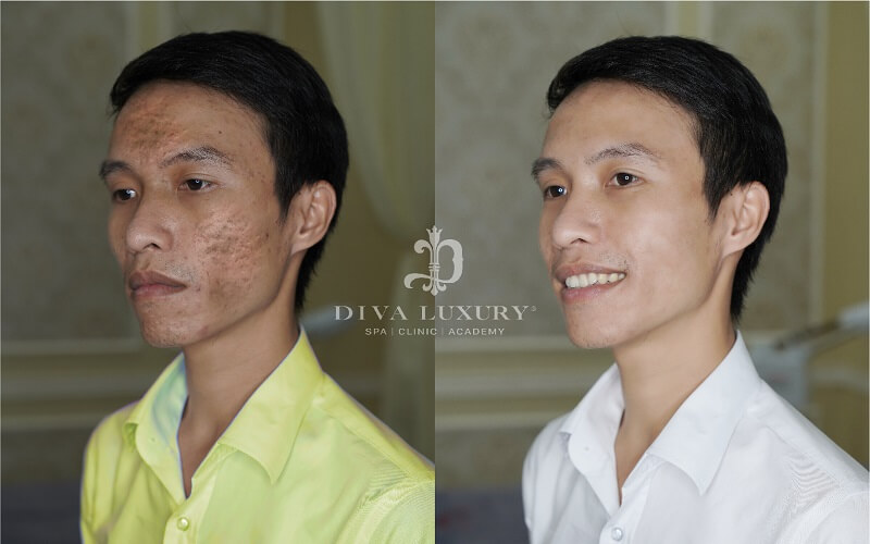 laser-fractional-co2-dac-tri-seo-ro-da-co-mat-tai-vien-tham-my-diva-3