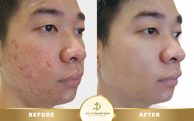 Trị sẹo trước sau