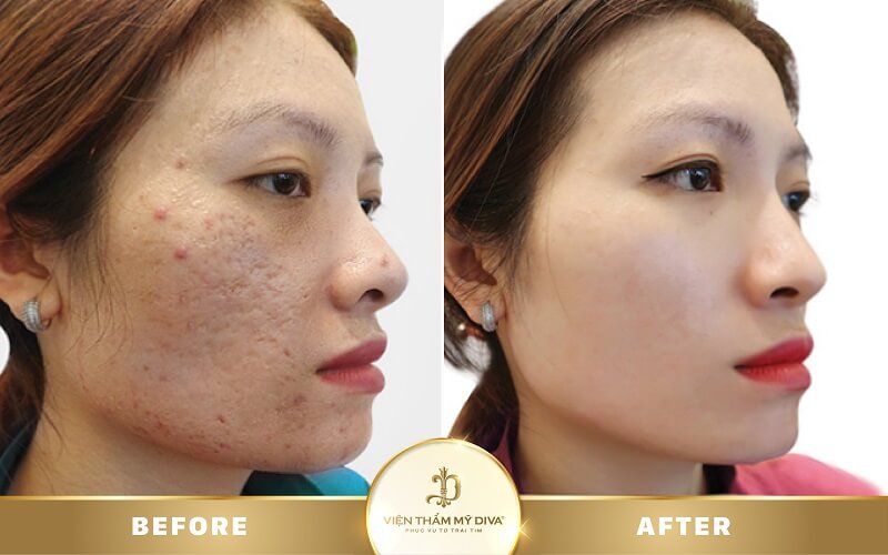 trị sẹo nhanh chóng