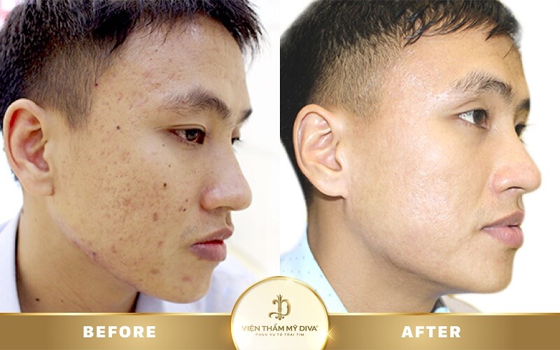trị sẹo uy tín