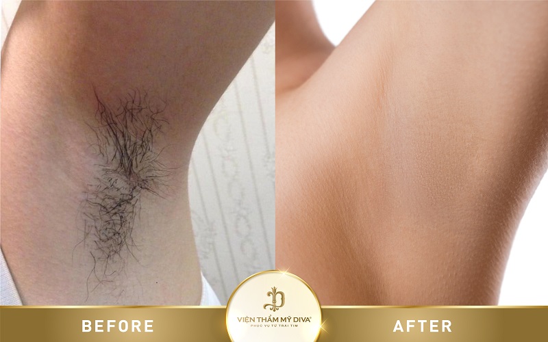 triệt lông nách trước sau