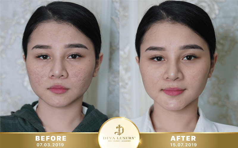 tri-seo-tai-da-nang-7