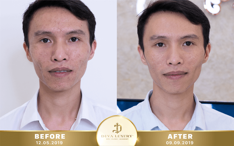 tri-seo-tai-da-nang-5