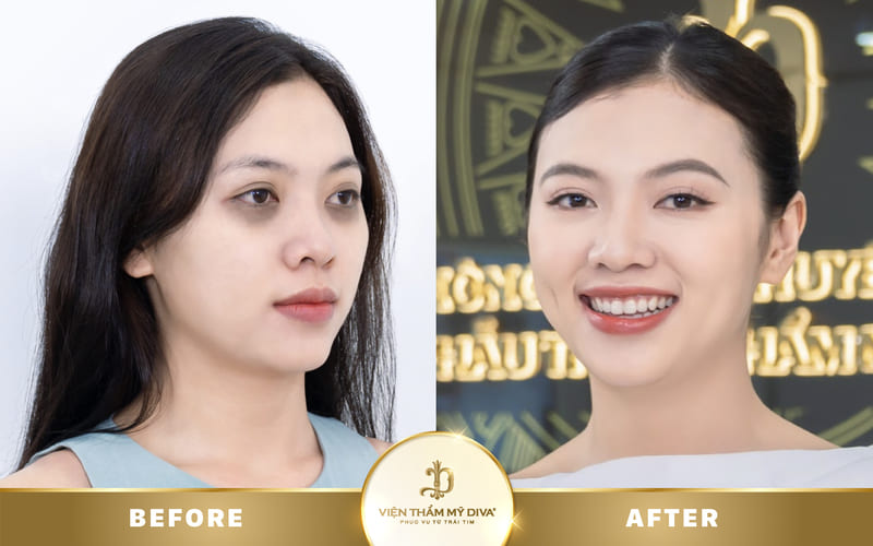 Trị thâm mắt