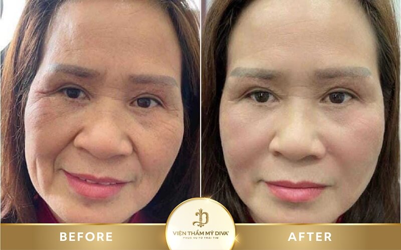 Hình ảnh của khách hàng sau khi xóa nếp nhăn tại Viện thẩm mỹ DIVA