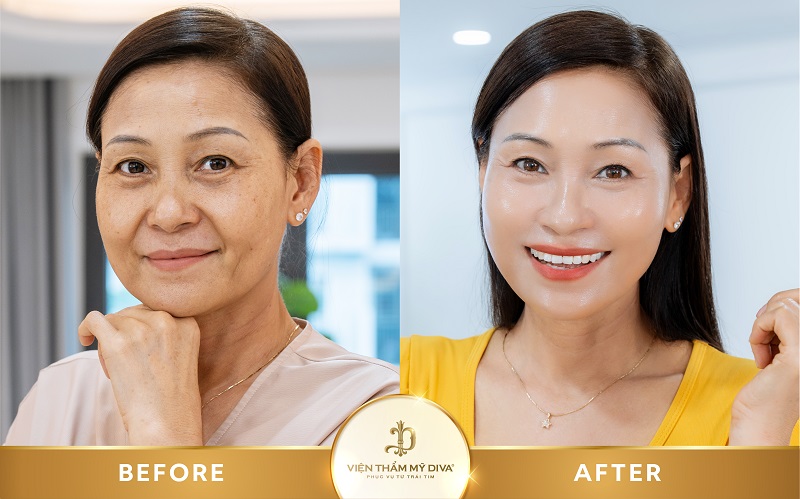 Hình ảnh của khách hàng sau khi xóa nếp nhăn tại Viện thẩm mỹ DIVA