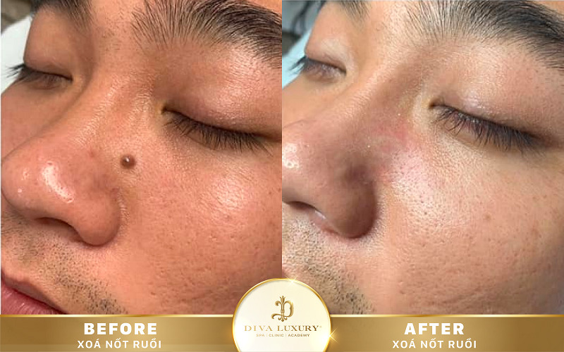 xoa-not-ruoi-o-duc-trong-8