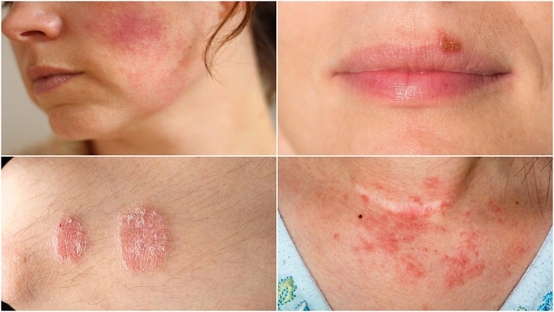 Hậu quả của việc xóa nốt ruồi tại trung tâm kém chất lượng là bị sẹo