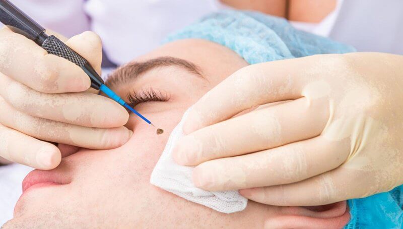 xóa nốt ruồi