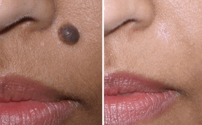 xoa-not-ruoi-da-nang xoa-not-ruoi-tai-da-nang-7