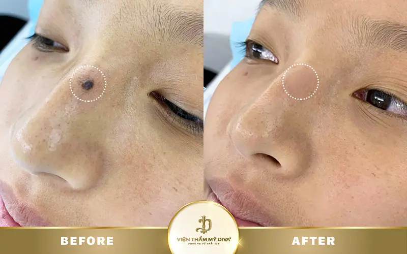 Ý Nghĩa Nốt Ruồi Ở Háng (Bẹn): May Mắn, Giàu Sang & Vượng Phu Ích Tử? 7
