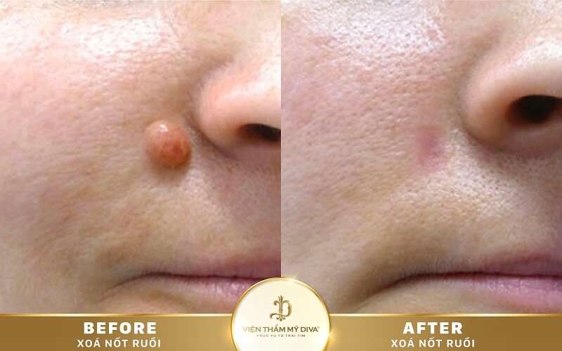 xoa-not-ruoi-o-duc-trong-10