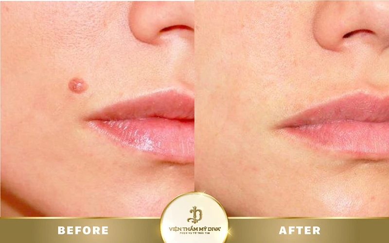 Nốt ruồi ở ngón chân út có ý nghĩa gì? Tướng số Tốt/ Xấu? 8